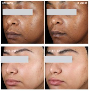 PHYTO A+ BRIGHTENING TREATMENT Before & After